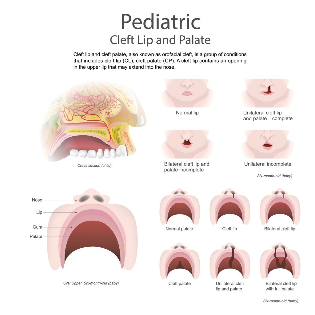 Cleft lip and Palate speech therapy